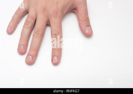 Une main sur un fond blanc dont les ongles sont mordu et déchiré, une mauvaise habitude, close-up, copiez l'espace, la médecine, l'ongle, l'arrière-plan Banque D'Images