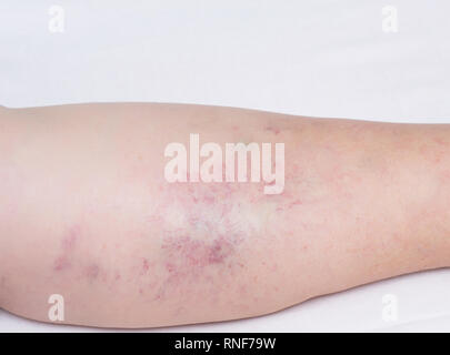 Jambe féminin sur un fond blanc avec des vaisseaux capillaires rouges, varices sur les jambes d'une femme âgée, close-up, fond blanc, phlebeurysm Banque D'Images