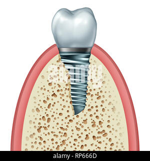 Les Implants dentaires intraosseux ou à l'intérieur de la prothèse dentaire de l'os de la mâchoire et du tissu des gencives avec une couronne d'orthodontie abutement et vis en métal. Banque D'Images