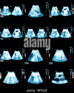 Image échographie (ultrasons) de l'abdomen Banque D'Images