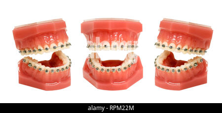 Modèle de dents, mâchoires avec appareil dentaire câblé métallique installé, isolé sur fond blanc et vue sous trois angles différents Banque D'Images