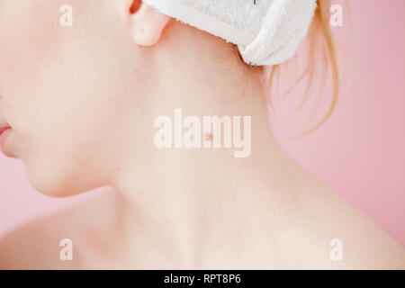 Plan rapproché sur le dos d'une femme sur une femme avec ses cheveux attachés pour révéler trois grains de beauté avec un grand sous sa ligne de cheveux. Banque D'Images