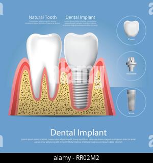 Les dents et les implants dentaires Vector Illustration Illustration de Vecteur