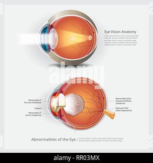 Anatomie de l'œil avec des anomalies oculaires Vector Illustration Illustration de Vecteur