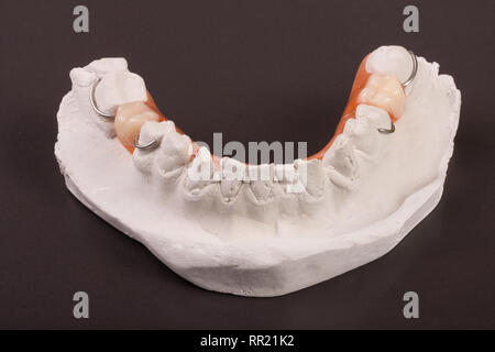 Plâtre de dents avec une prothèse partielle amovible sur fond sombre Banque D'Images