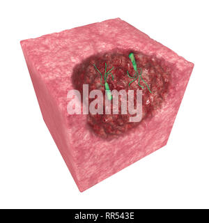 Helicobacter pylori est une bactérie microaérophile habituellement trouvés dans l'estomac. Il est présent dans une personne avec la gastrite chronique et les ulcères gastriques. Banque D'Images