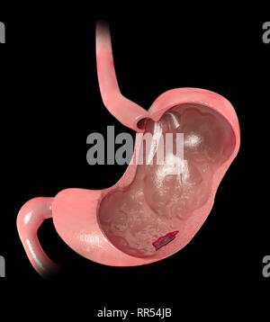 La Section 3d de l'estomac. Ulcère gastro-duodénal, l'ulcère gastrique est une rupture de la paroi interne de l'estomac. L'Helicobacter pylori Banque D'Images