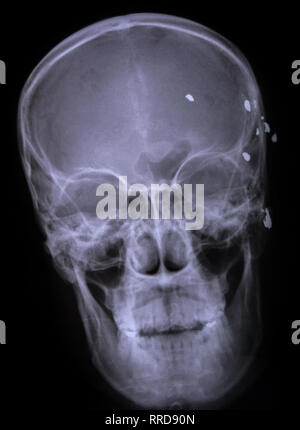 X ray image d'une balle de fusil dans la tête. Banque D'Images