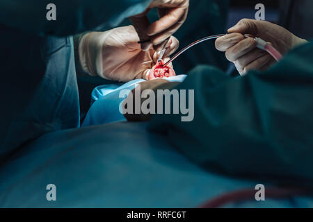 Chirurgie esthétique sur le nez. Le chirurgien coupe la chair Banque D'Images