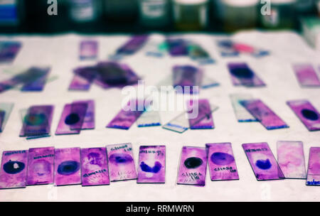 Vitraux transparents de frottis de sang périphérique avec le violet leishman giemsa en hématologie pathology laboratory Banque D'Images