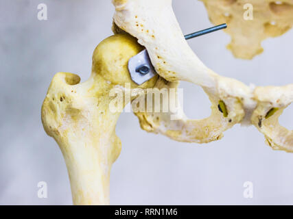 L'os de la hanche articulée et tête du fémur montrant les droits de l'hanche anatomie en fond blanc Banque D'Images