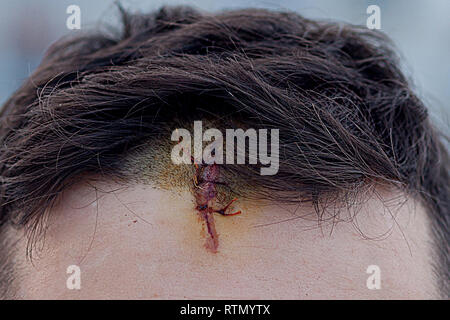 Blessure au crâne avec Suture, fils de couture craniectomy postopératoire avec beaucoup d'agrafes, de la technologie médicale la couture. Banque D'Images