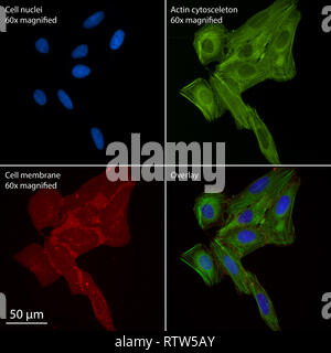 Plusieurs cellules d'ostéosarcome humain à épifluorescence vitraux Banque D'Images