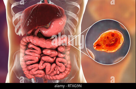 Balantidiasis, conceptual image. Illustration de l'ordinateur vue rapprochée de protozoaire cilié Balantidium coli, un parasite intestinal le causati Banque D'Images