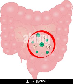 L'infection au virus de l'intestin grêle sign vector illustration Illustration de Vecteur