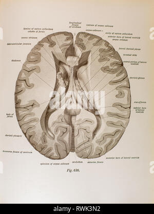 La dissection de cerveau humain montrant l'intérieur, la matière grise, de l'occipital, temporal et le lobe pariétal. Banque D'Images