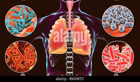 Les bactéries qui causent des infections pulmonaires, illustration Banque D'Images
