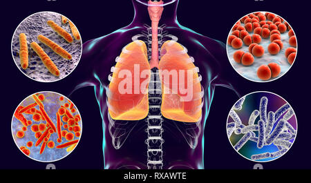 Les bactéries qui causent des infections pulmonaires, illustration Banque D'Images