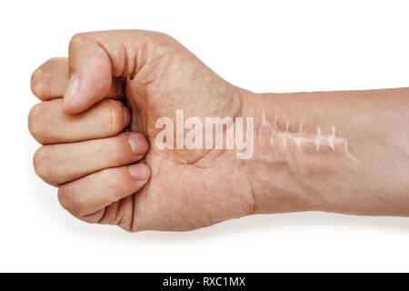 Cicatrice avec points de suture sur les doigts après la chirurgie. Fracture de l'os des mains en poing isolé sur fond blanc Banque D'Images