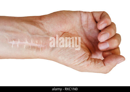 Cicatrice avec points de suture sur les doigts après la chirurgie. Fracture de l'os des mains en poing isolé sur fond blanc Banque D'Images