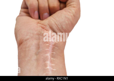 Cicatrice avec points de suture sur les doigts après la chirurgie. Fracture de l'os des mains en poing isolé sur fond blanc Banque D'Images