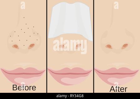 Les points noirs sur le nez vector illustration montrant les problèmes de peau Illustration de Vecteur