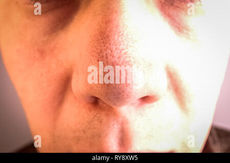 Un homme avec de grands pores et les points noirs sur le nez. Banque D'Images