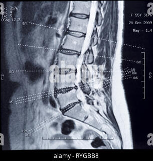 Du vrai IRM de la colonne vertébrale, les données du patient hors clonés Banque D'Images