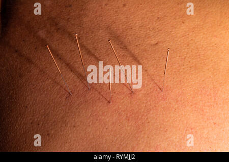 Plusieurs aiguilles d'acupuncture pour faire le traitement. La médecine traditionnelle chinoise fait avec l'insertion d'aiguilles dans des endroits précis du corps. N acier Banque D'Images