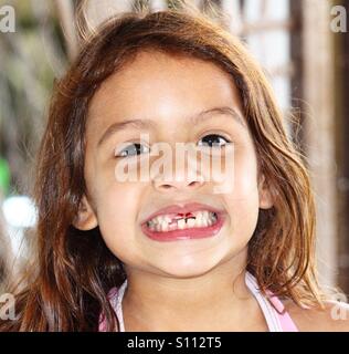 Petite fille qui manque ses 2 dents de devant. Banque D'Images