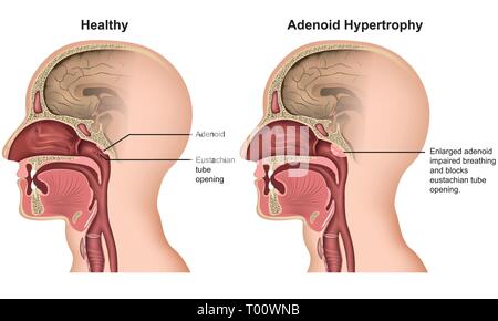 Hypertrophie adénoïde vector illustration médicale sur fond blanc Illustration de Vecteur