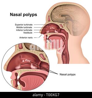 Polypes nasaux vector illustration médicale sur fond blanc Illustration de Vecteur