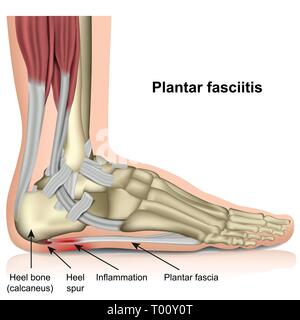 La fasciite plantaire médicale 3d vector illustration sur fond blanc Illustration de Vecteur