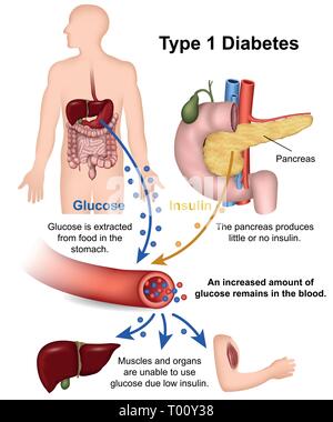 Le diabète de type 1 vector illustration médicale avec description en anglais Illustration de Vecteur