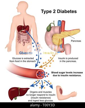 Le diabète de type 2 vector illustration médicale avec description en anglais Illustration de Vecteur