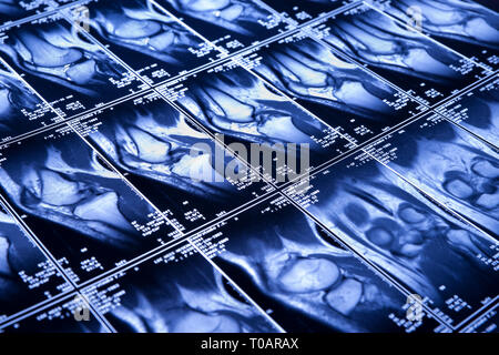 Mon genou IRM - traumatologie du sport, dégâts des ligaments en forme de croix Banque D'Images