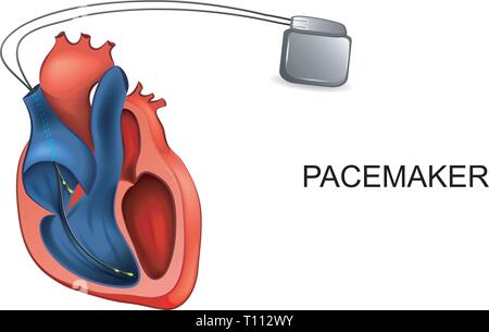 Vector illustration de l'insuffisance cardiaque et cardiologie pacemaker. Illustration de Vecteur