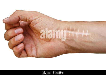 Cicatrice avec points de suture sur les doigts après la chirurgie. Fracture de l'os des mains en poing isolé sur fond blanc Banque D'Images