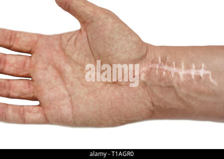 Cicatrice avec points de suture sur les doigts après la chirurgie. Fracture de l'os des mains en poing isolé sur fond blanc Banque D'Images