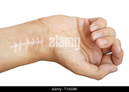 Cicatrice avec points de suture sur les doigts après la chirurgie. Fracture de l'os des mains en poing isolé sur fond blanc Banque D'Images