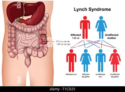 Le syndrome de Lynch maladie médicale 3d vector illustration sur fond blanc Illustration de Vecteur