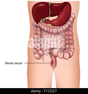 Cancer du rectum medical illustration vecteur 3d sur fond blanc, le cancer colorectal Illustration de Vecteur