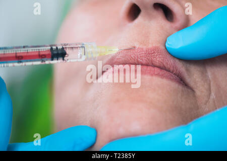 Injections d'acide hyaluronique. Femme mature reçoit des injections d'acide hyaluronique pour réduire les rides autour des lèvres et de la bouche- orientée vers la bouche. Banque D'Images