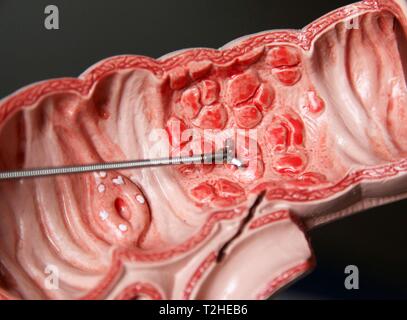 La coloscopie, l'élimination des excroissances dans l'intestin humain sur un modèle médical, Allemagne Banque D'Images