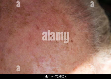 Close up de personnes âgées mans front avec la peau écailleuse précancéreuses caouse par le soleil. Traumatisme de bronzage sur la peau. Banque D'Images