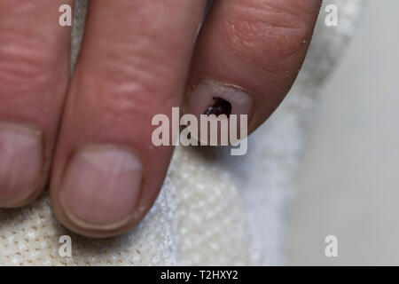 Ongle hématome subungual blister de sang close up sur les personnes âgées mans ongle. Banque D'Images