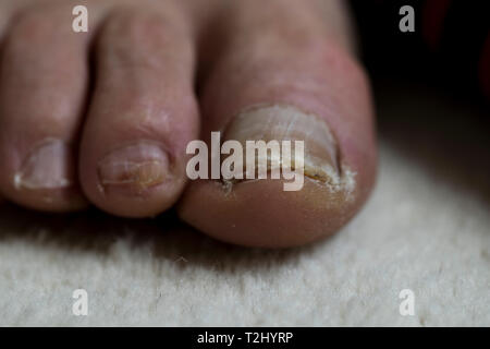 Gros orteil avec clou dommage. Personnes âgées mans pieds close up avec un traumatisme de l'ongle. Pieds close up concept soins médicaux. Banque D'Images