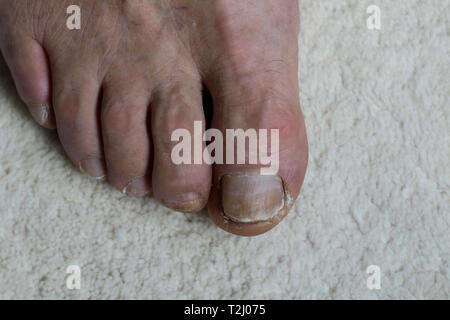 Personnes âgées mans pieds close up avec le mycète d'endommagement. Blessé et poussé sur des pieds de près. Pieds et orteils macro-vision. Banque D'Images