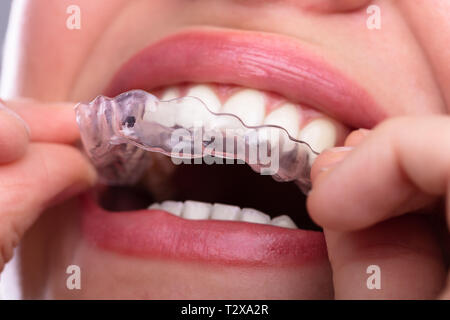 Close-up of a Woman's Hand Putting Alignement Transparent dans les dents Banque D'Images