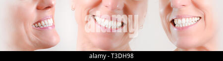 Ensemble de trois vues d'une dentition blanche naturelle d'une femme de race blanche avec des boucles d'or Banque D'Images